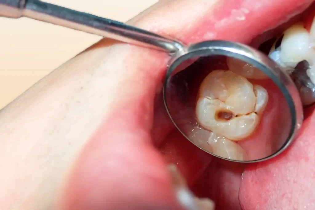 Răng mới bị sâu chỉ nên làm sạch mô sâu rồi trám răng để phục hồi